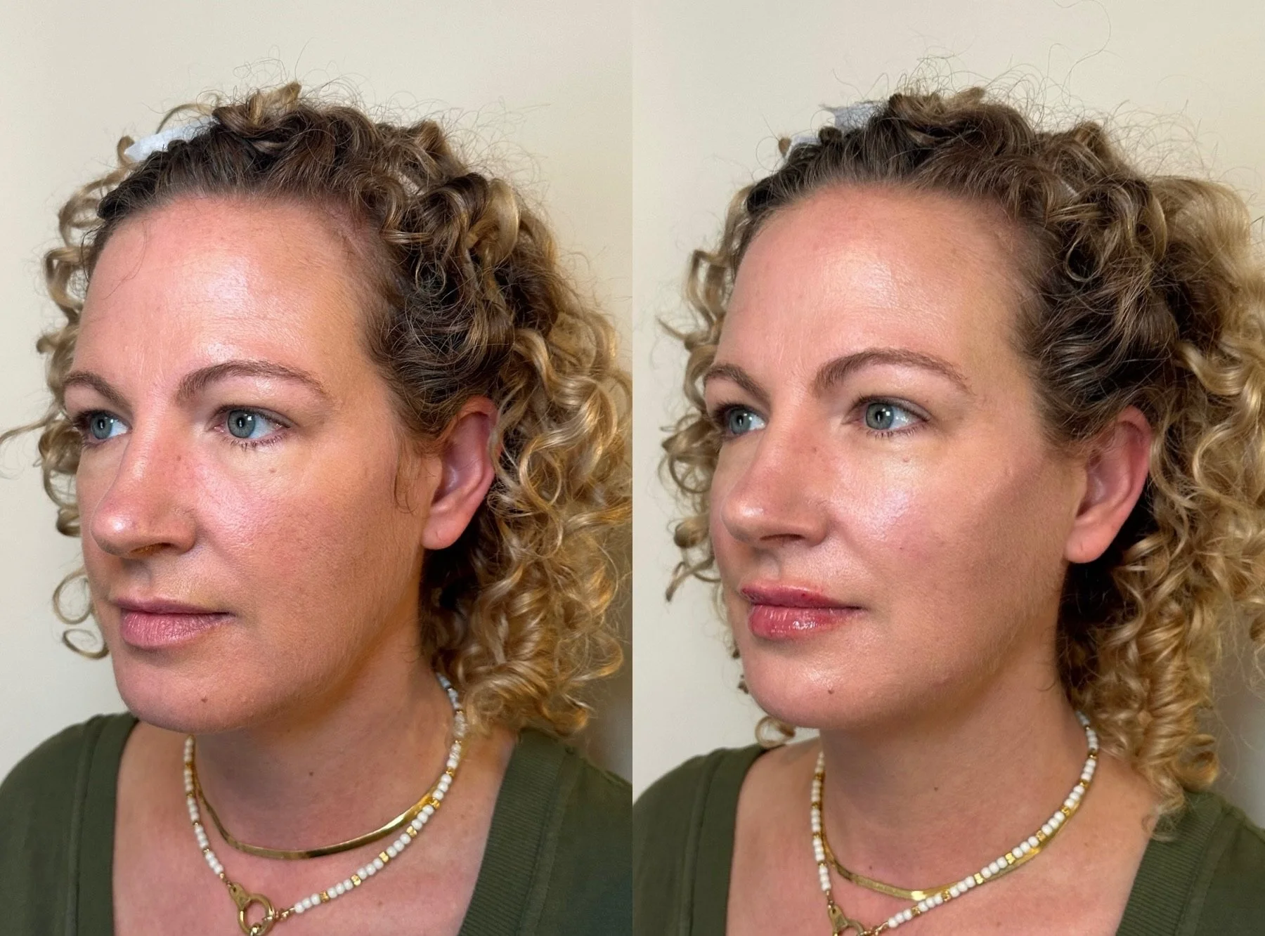 full facial balancing