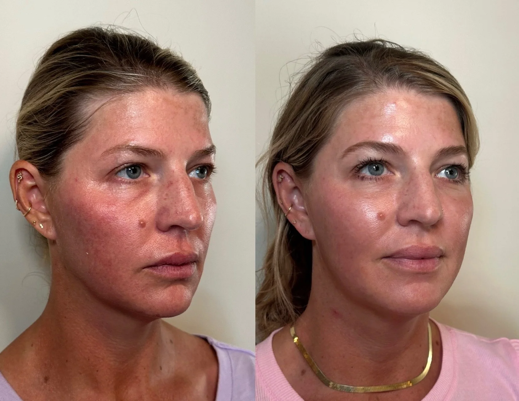 full facial balancing