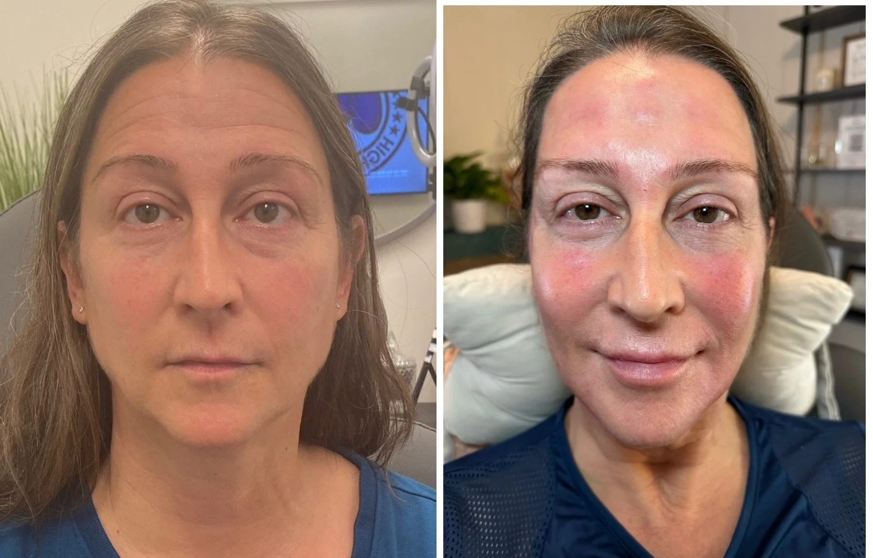 full facial microneedling