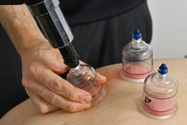 Cupping Therapy in Geelong &amp; The Bellarine: How We Use It to Get You Moving