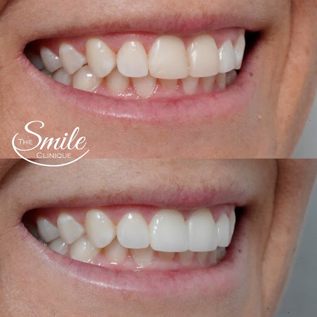 It is so nerve racking to trust someone with the first thing about you that people notice, your smile!
One of the most common fears people face when considering porcelain veneers is &ldquo;how are they going to blend in with the rest of my teeth??&rd