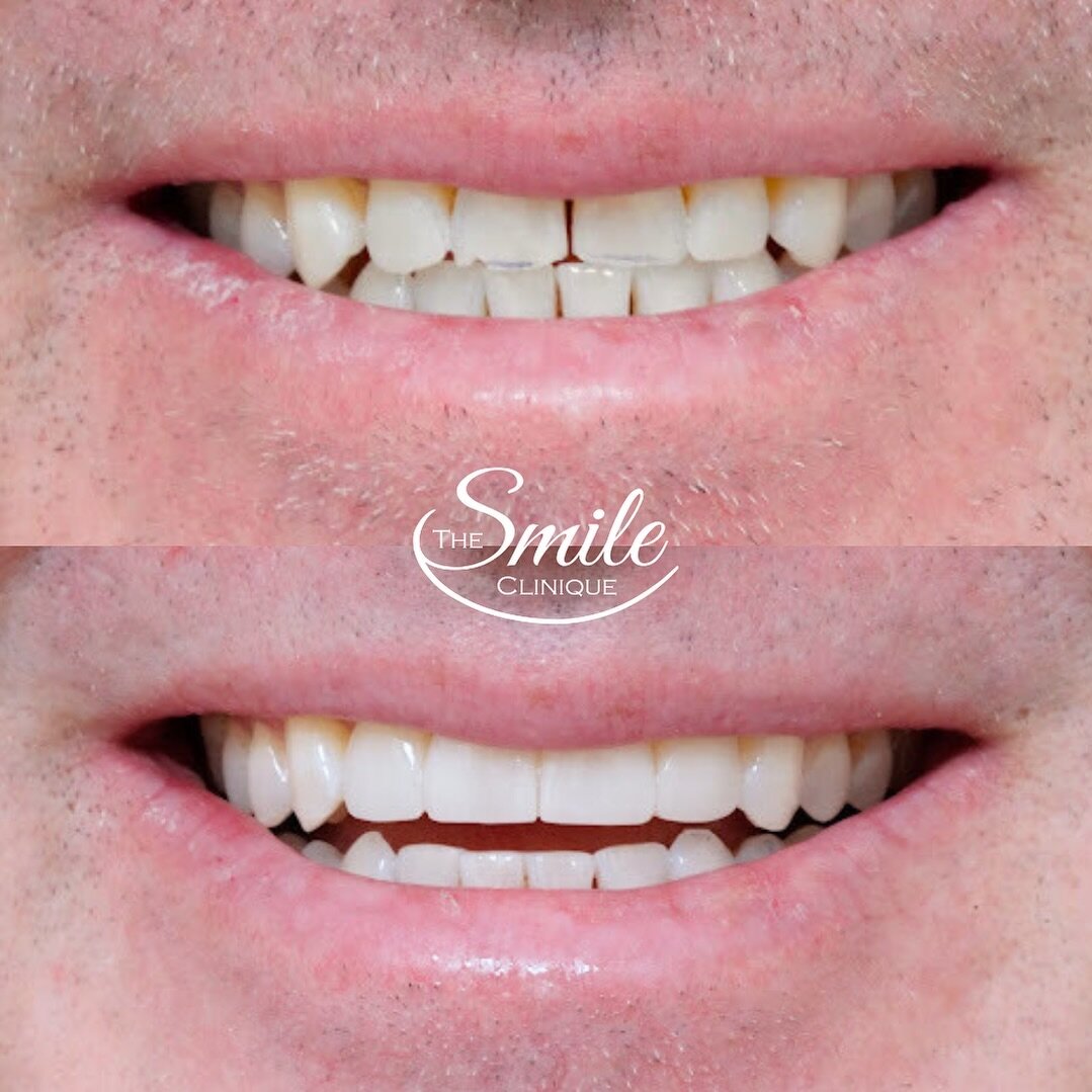 ✨Individuality✨
Our patient asked specifically for very natural results and no significant increase in length of his teeth. His concerns were limited to restoring chipping, spacing and translucency. We followed the brief and achieved his ideal result