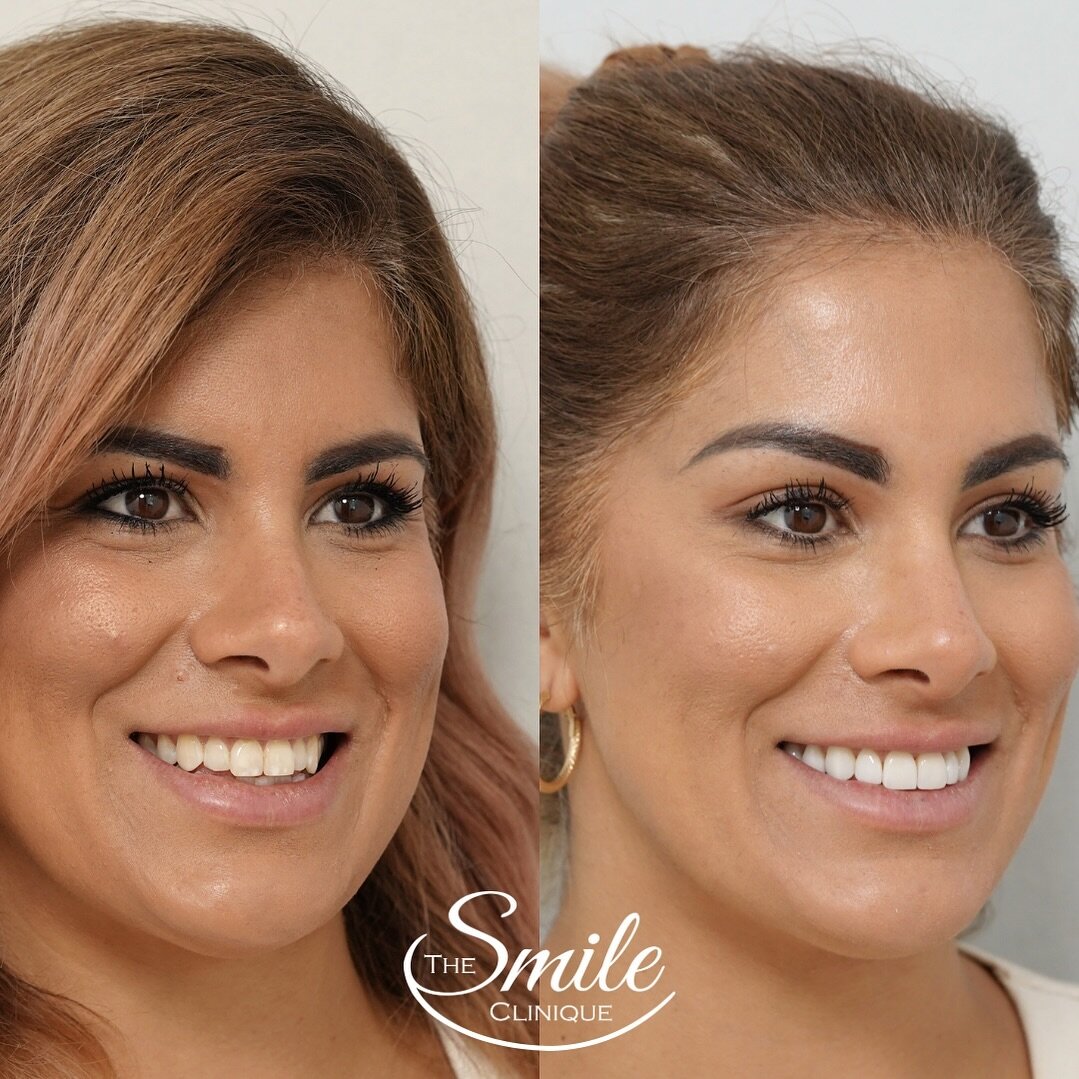 How lucky are we? We get to make dreams come true every day!
@sabinahobbs before and after 10 premium porcelain veneers to
✨Resolve white spotting on enamel
✨Brighten shade
✨Widen smile
✨Create the appearance of straight teeth
We appreciate you comin