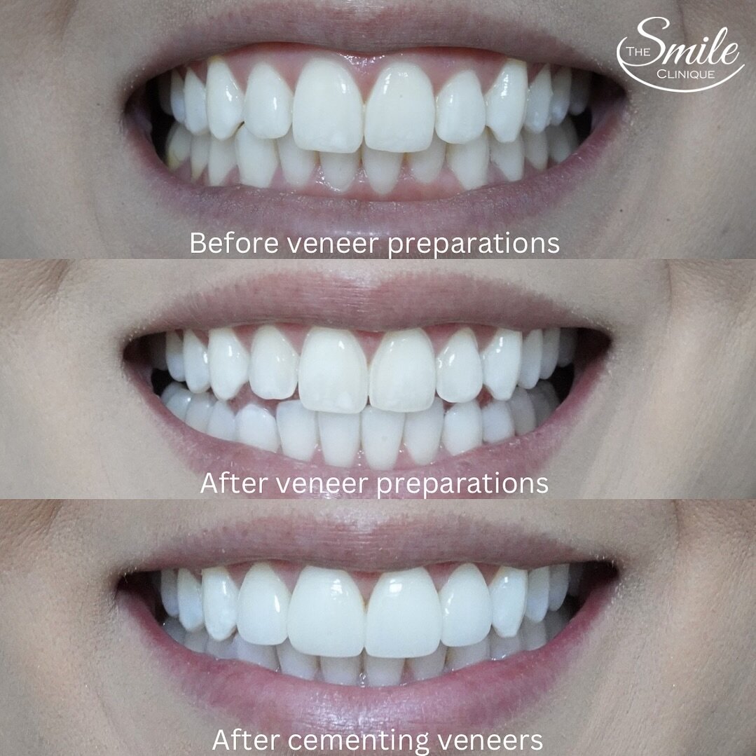 ✨Minimally invasive porcelain veneers✨
We are often asked how much tooth structure we need to reduce in order to place porcelain veneers.
Here is an example a patient before any enamel reduction, after reduction and after cementation of 4 premium por