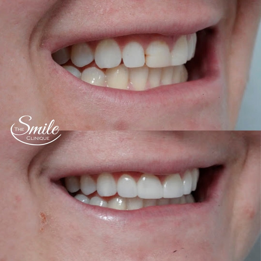 ✨Exceeding expectations✨
Our porcelain veneers are designed to not just meet our patients&rsquo; smile goals but to smash them! 
What did we do here?
✨Selective laser gum lift
✨Teeth whitening 
✨4 porcelain veneers designed with our patients&rsquo; s