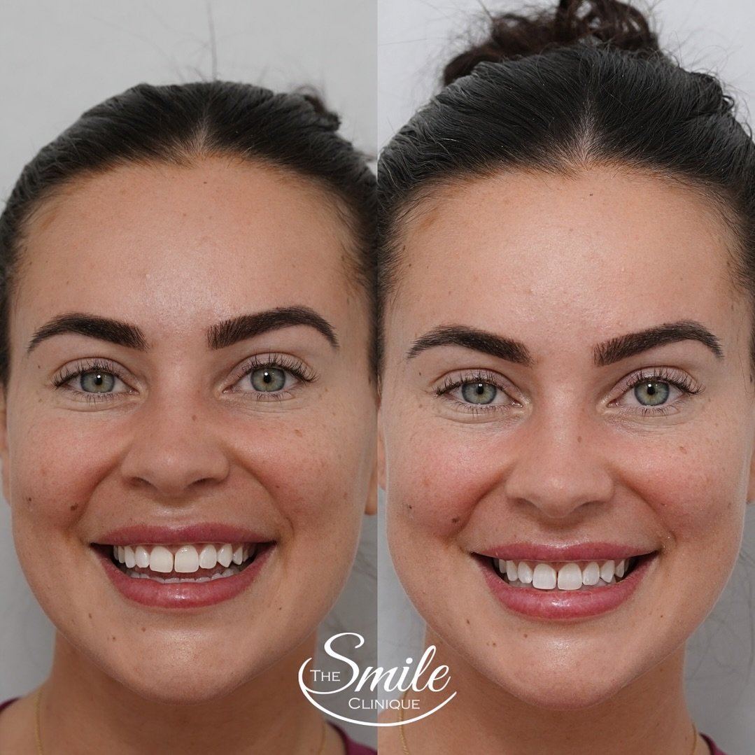 Very subtle composite bonding to adjust the shape of one tooth that was bothering the lovely @_bronteschofield 
#thesmilecliniqueperth  #perthcosmeticdentist 

*Please note all treatments have risks and benefits and treatment results vary from patien