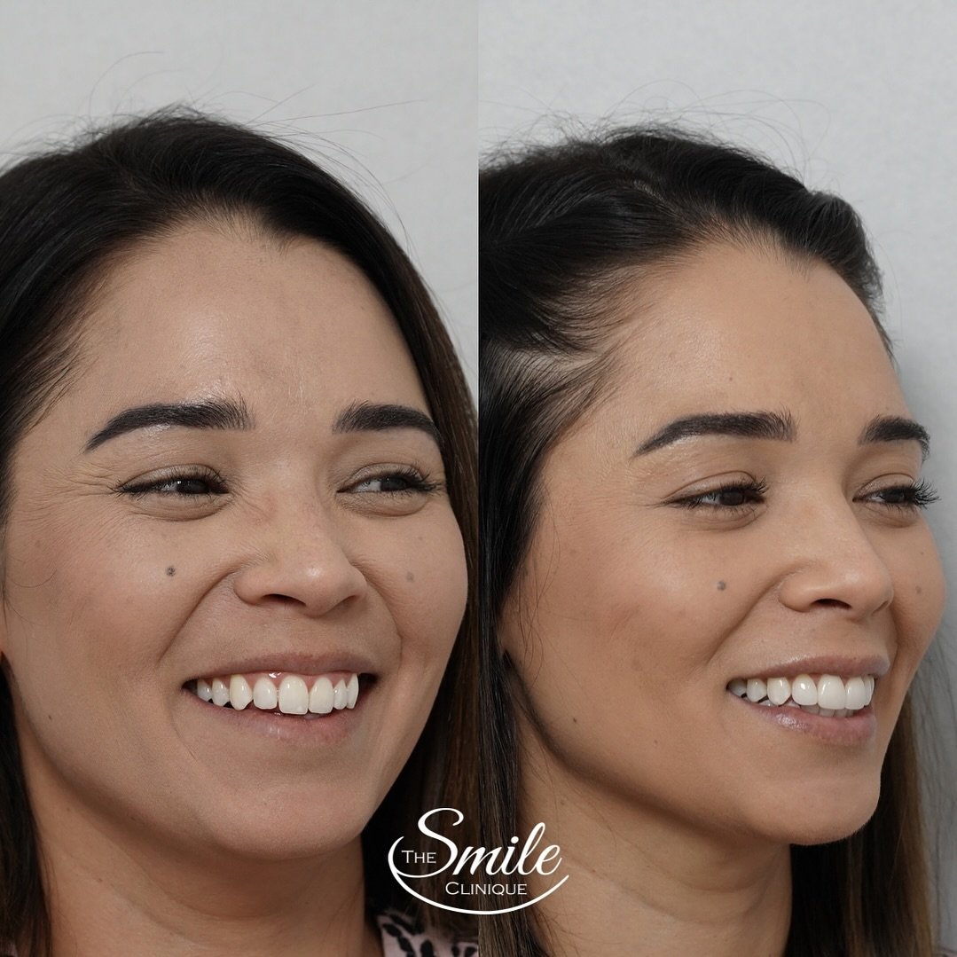 Subtle changes for this beauty! Before and after 4 premium porcelain veneers 
Contact us on 📞 0865580595 or email 📧 info@thesmileclinique.com.au to find out how we can help create your dream smile!
#thesmilecliniqueperth #perthcosmeticdentist 

*Pl