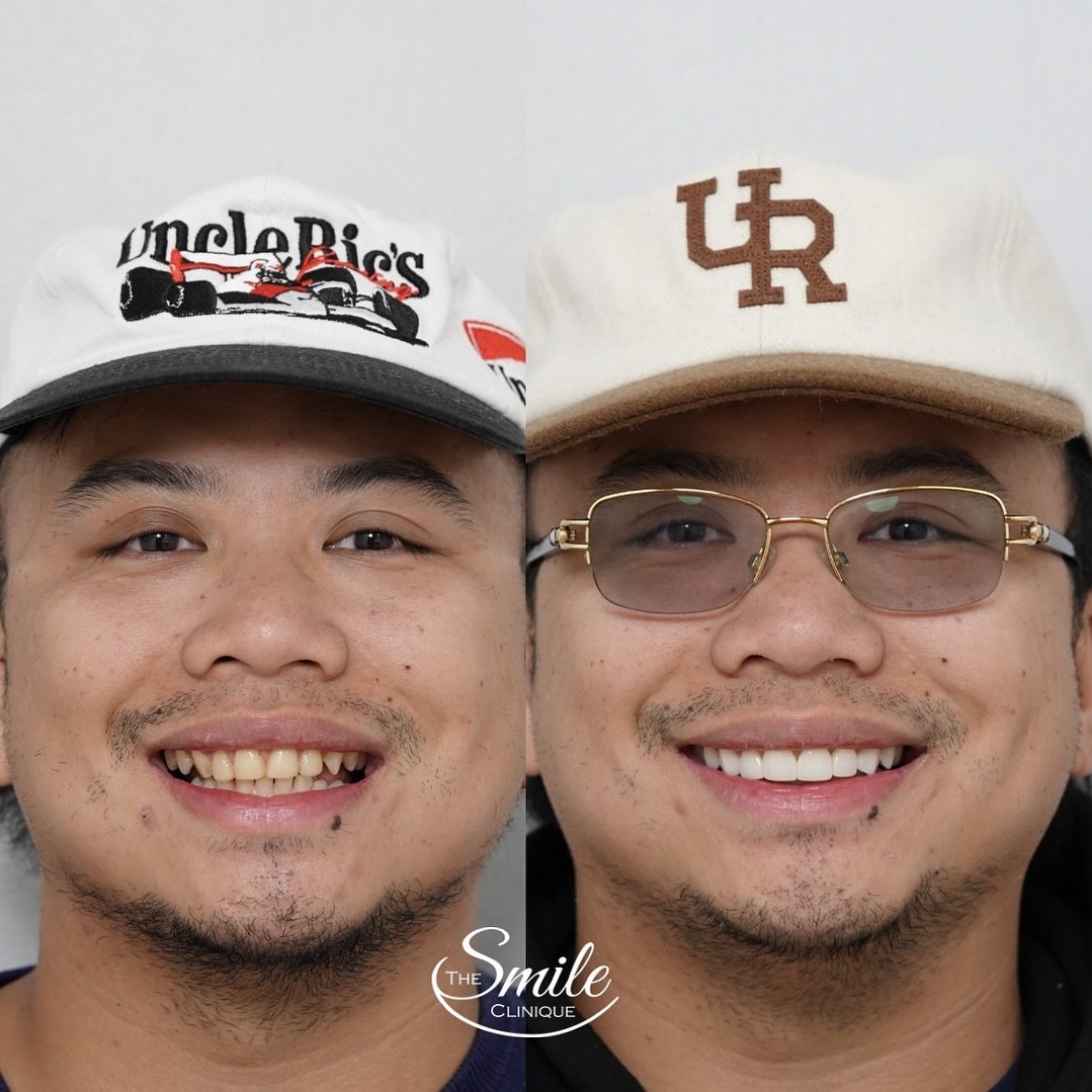 Life changing results!
We replaced stained, chipped composite veneers that were causing gum inflammation and plaque build up with 8 custom designed, premium porcelain veneers
✨CAUTION ✨ when considering overseas dentistry please understand the risks 
