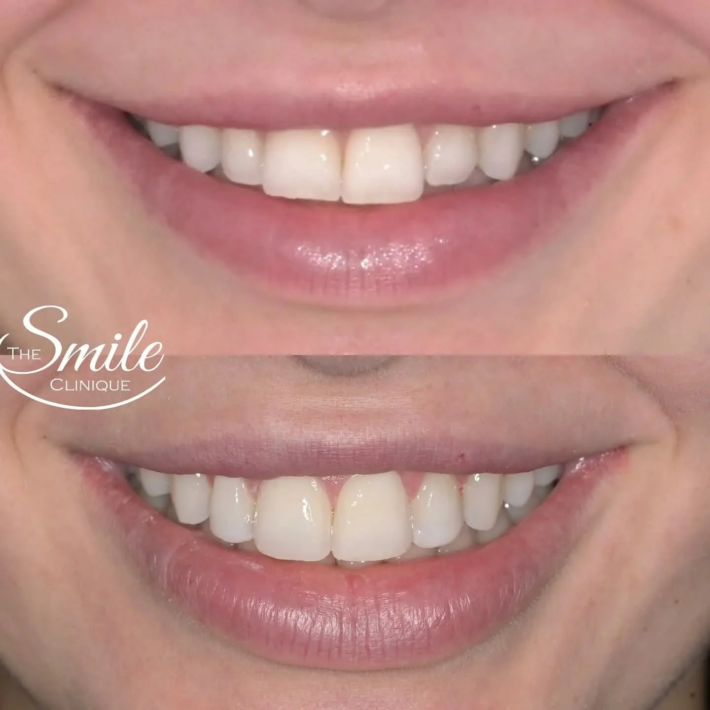 Visit our clinic in Subiaco for a veneer consultation! Call us at (08) 6558 0595 to book your appointment. 🦷✨

Please note: All treatments have risks and benefits, and results can vary from patient to patient. This content does not constitute medica