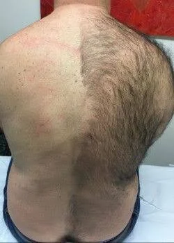 LASER HAIR REMOVAL-EXTRA LARGE