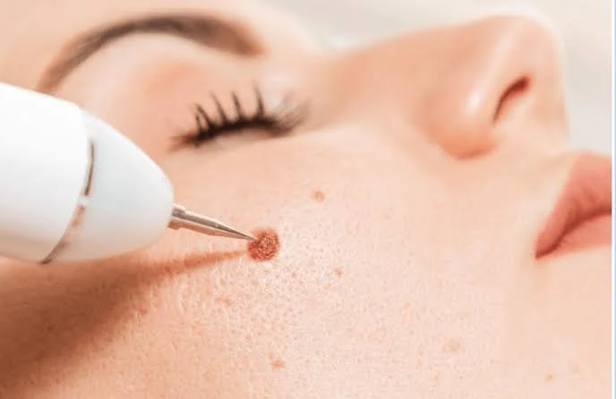 Mole/Skin Tags/Wart Removal