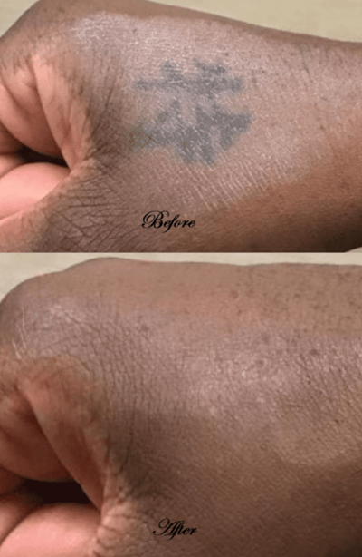 Tattoo Removal