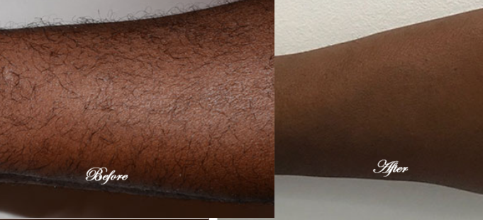 LASER HAIR REMOVAL-LARGE