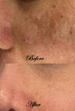 Hyperpigmentation Removal