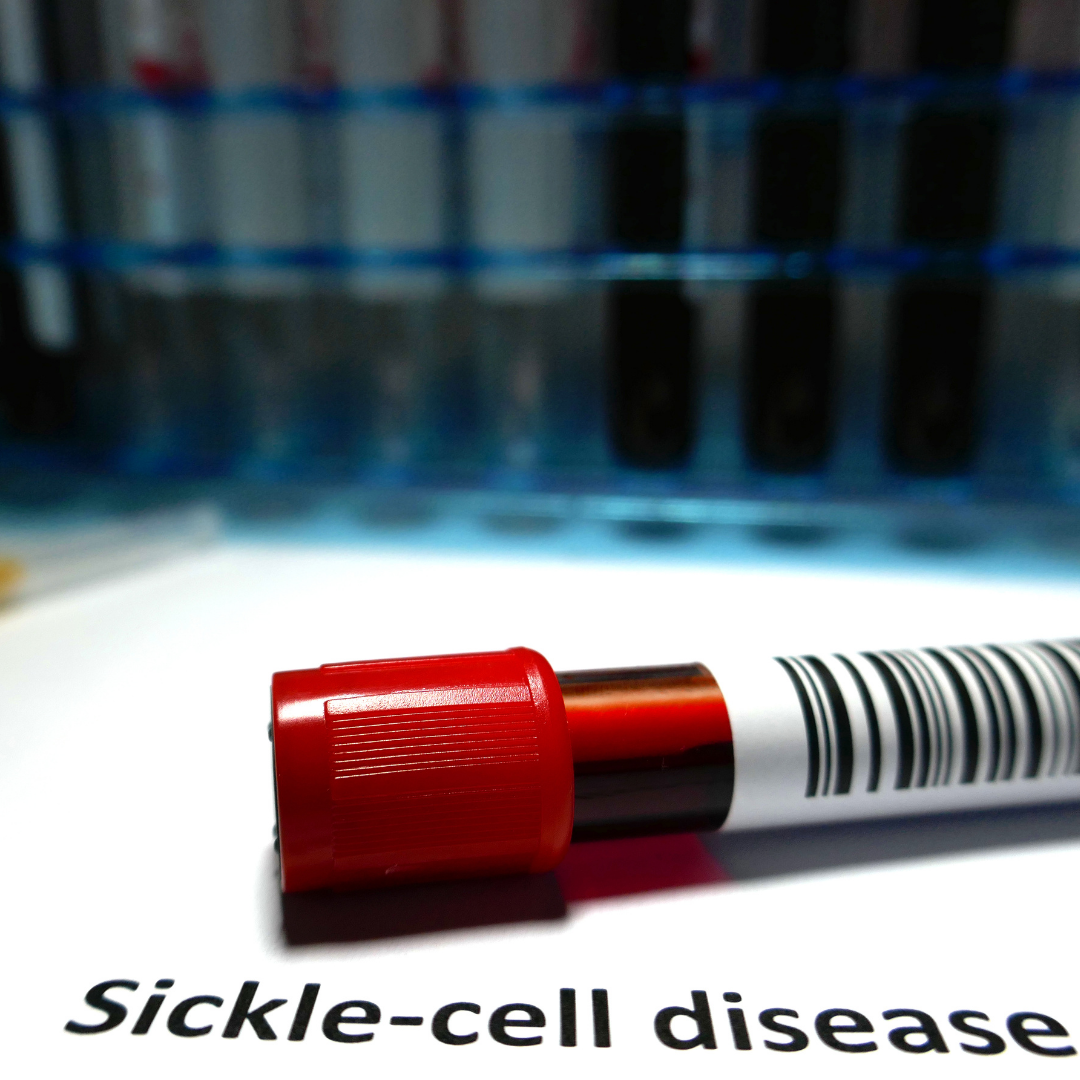 SUPPORTING SICKLE CELL ANEMIA WITH ACUPUNCTURE &amp; CHINESE MEDICINE: A HOLISTIC APPROACH