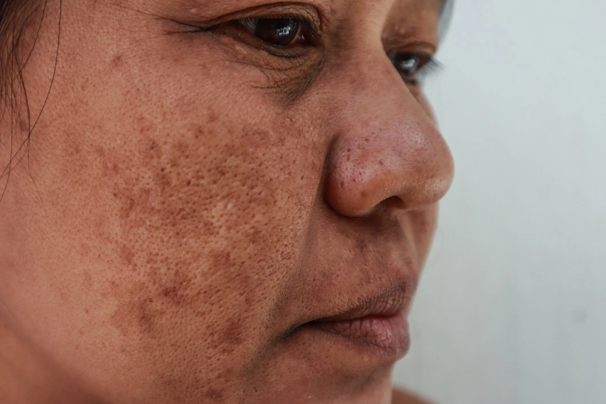 Close-up of a cheek showing patches of hyperpigmentation