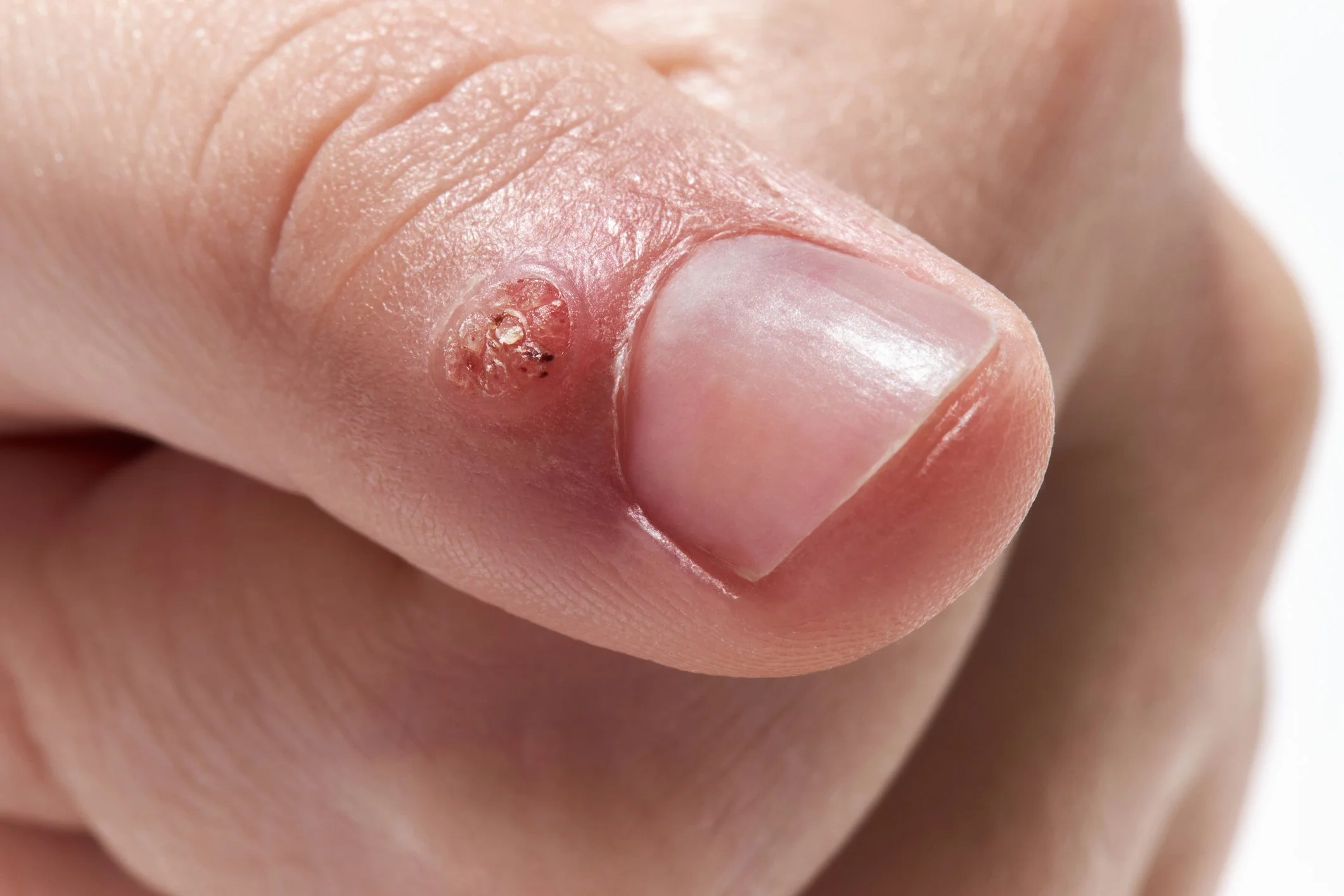 Close-up of a common wart on a finger