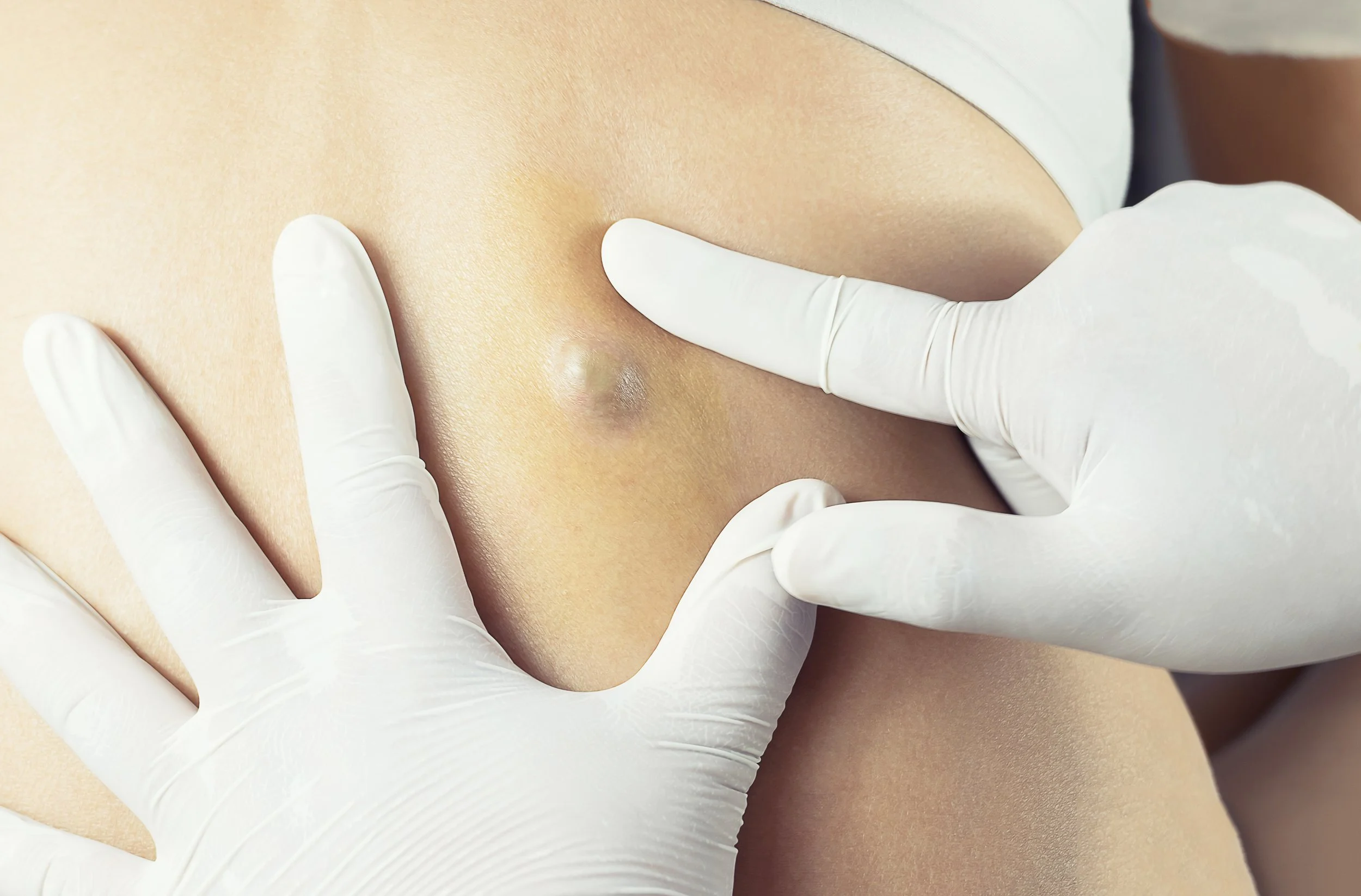 Gloved hands examining a small raised cyst on a patient's back