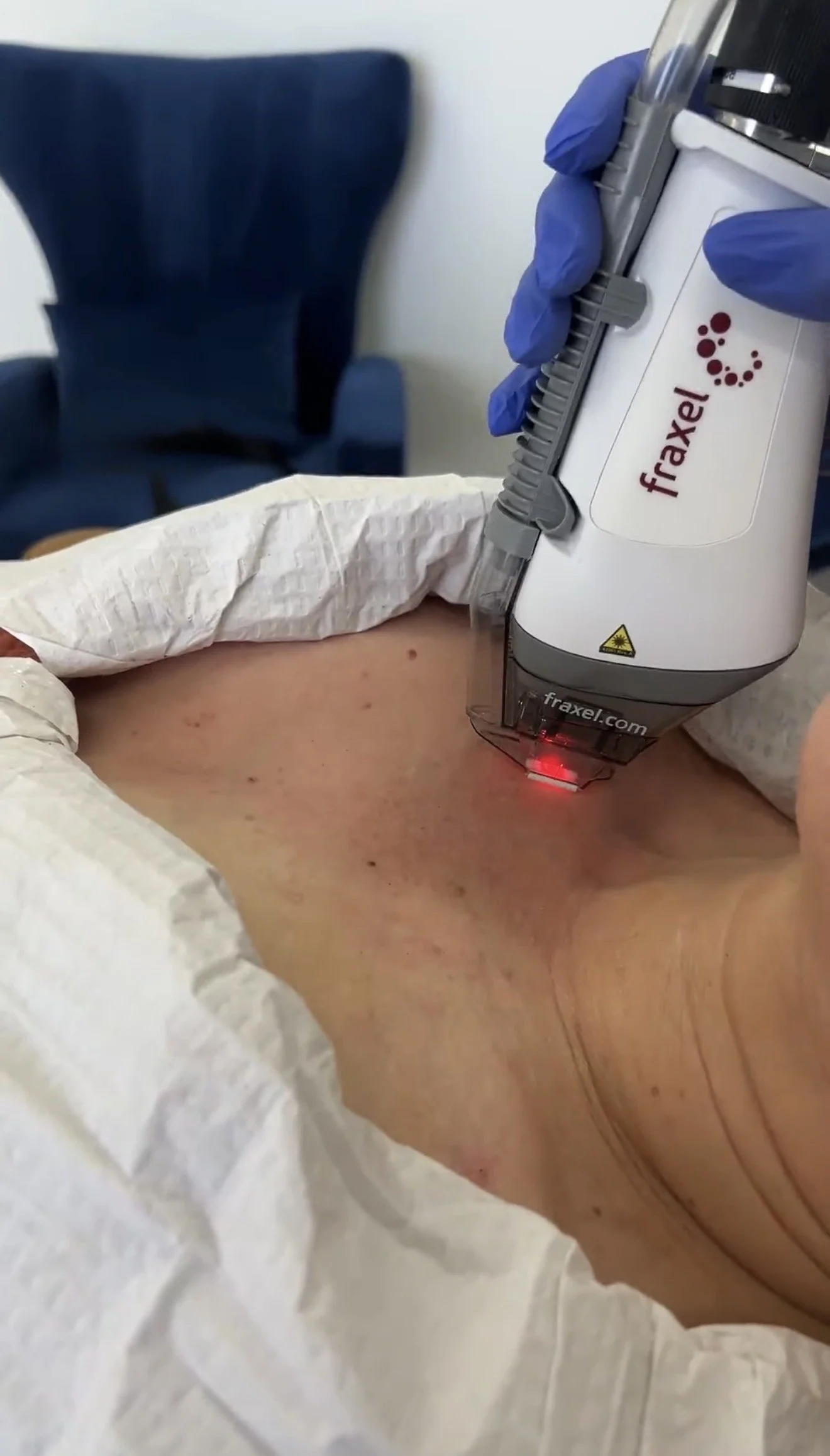 Patient's chest and décolletage with sun damage and brown spots, draped for a Fraxel treatment with the laser handpiece in position