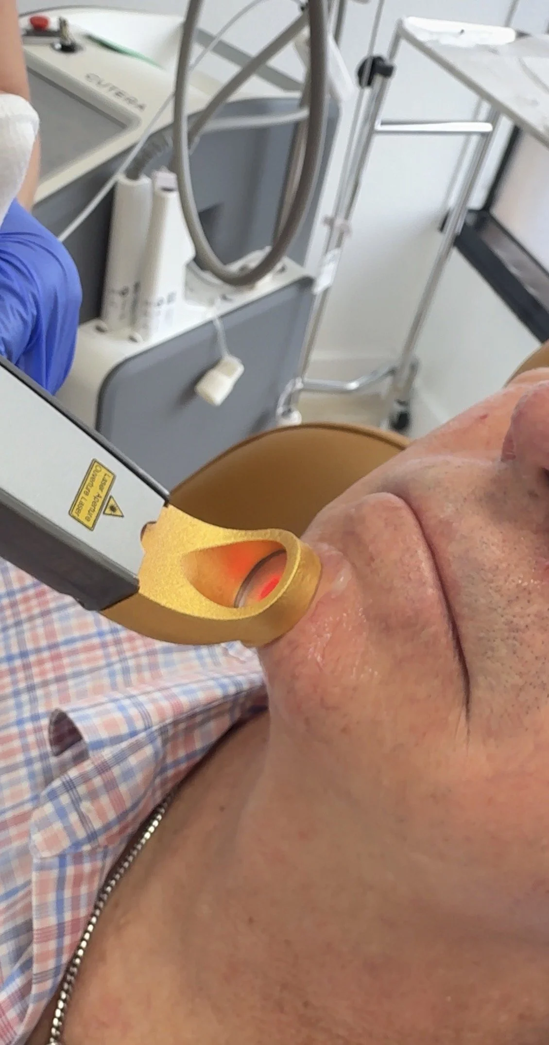 Excel V+ laser handpiece positioned against the skin beside a patient's nose, with the aiming beam visible