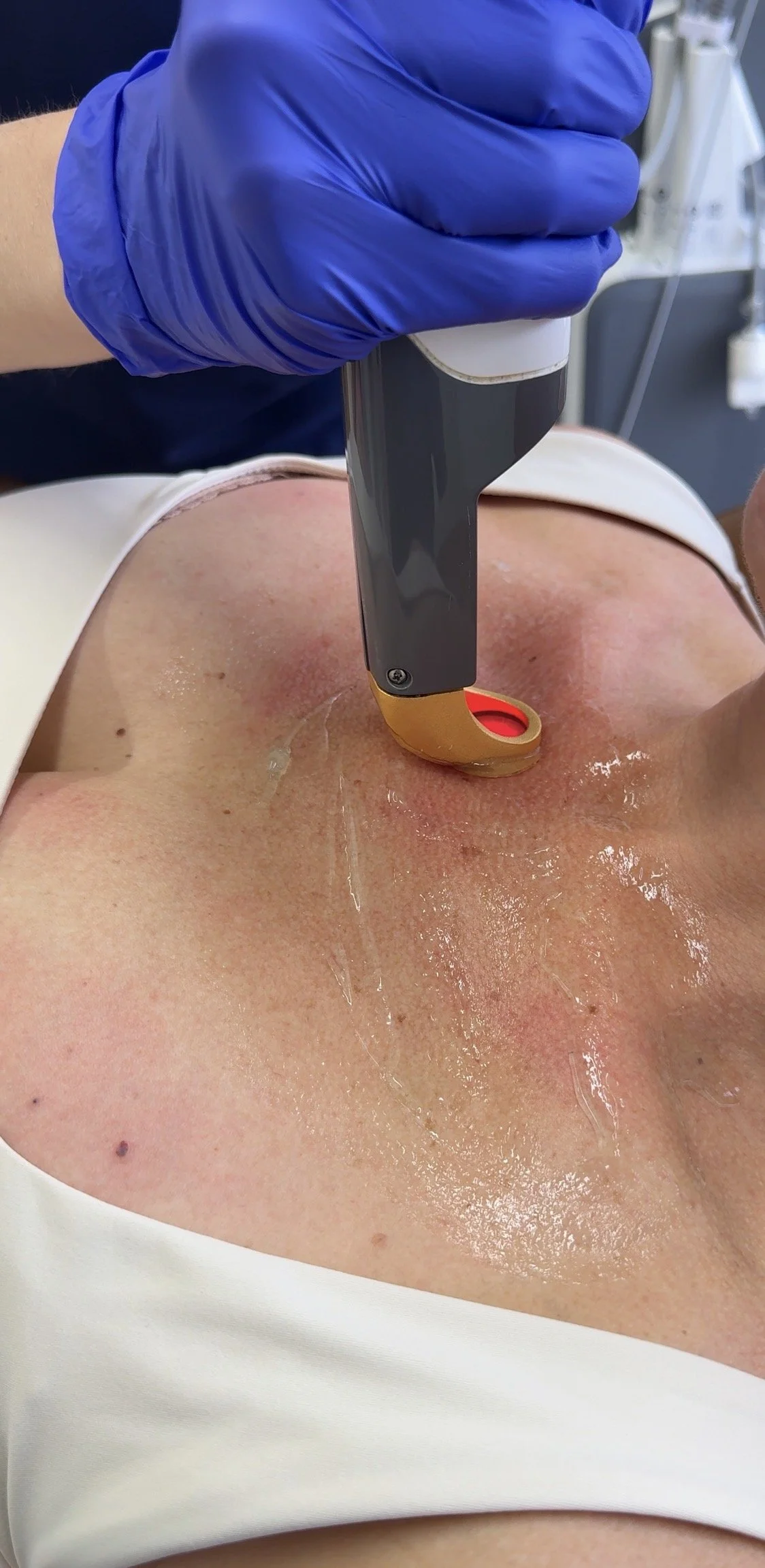 Excel V+ laser handpiece treating redness and visible vessels on a patient's chest and décolletage