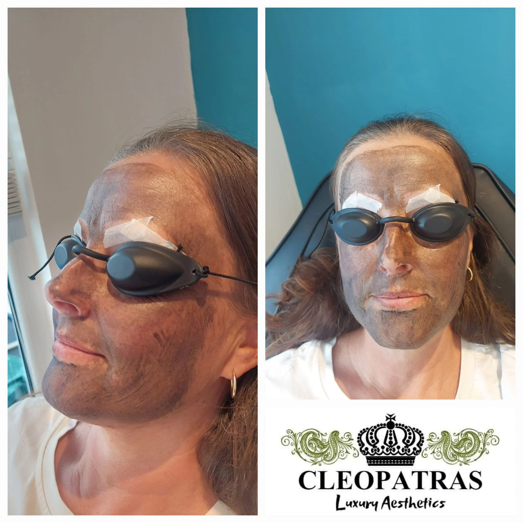Carbon Laser Facial