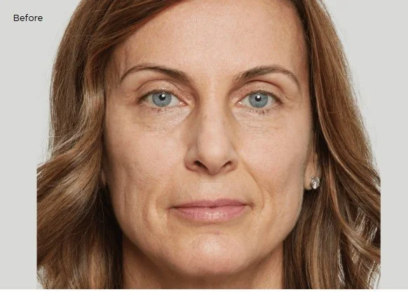 Sculptra 2 before.jpg