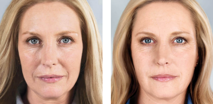 Sculptra in Pointe-Claire: Restoring Volume Naturally