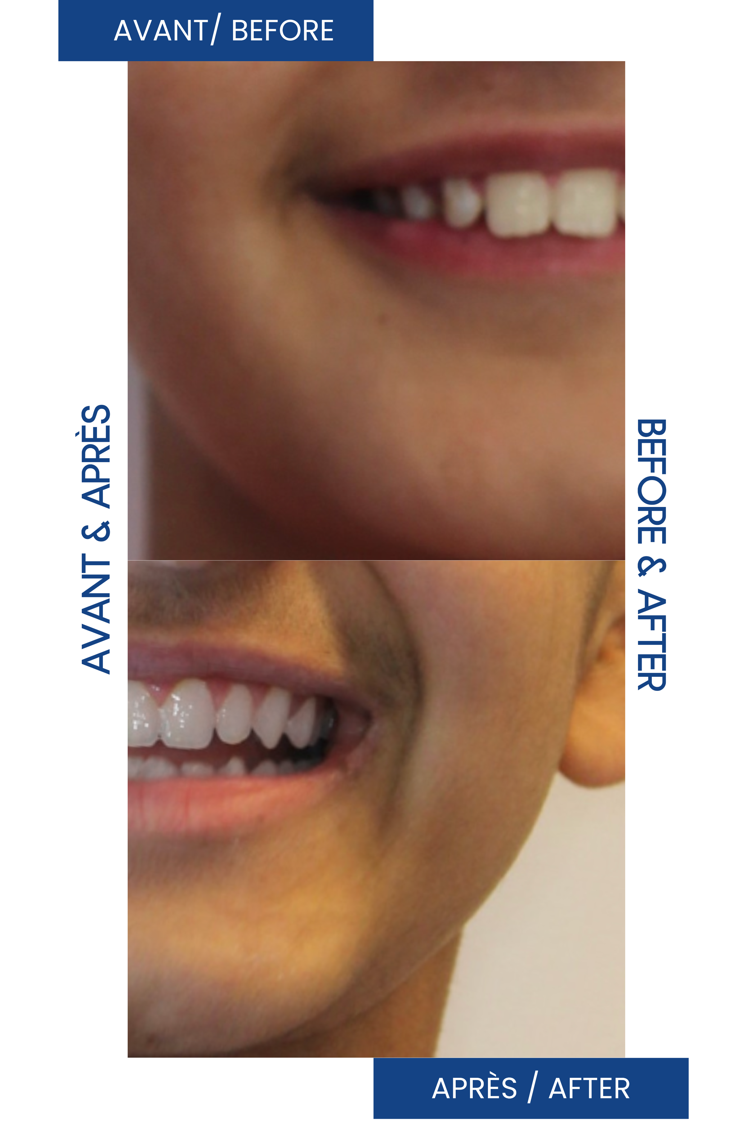 Comparaison de dents avant et après un traitement, montrant une amélioration de l'apparence des dents, avec un sourire plus blanc et aligné dans la partie après.