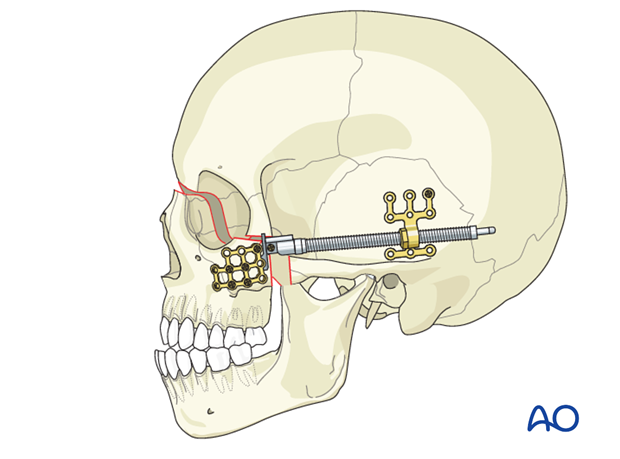 Cleft Lip and Plate and other Syndromes part 3
