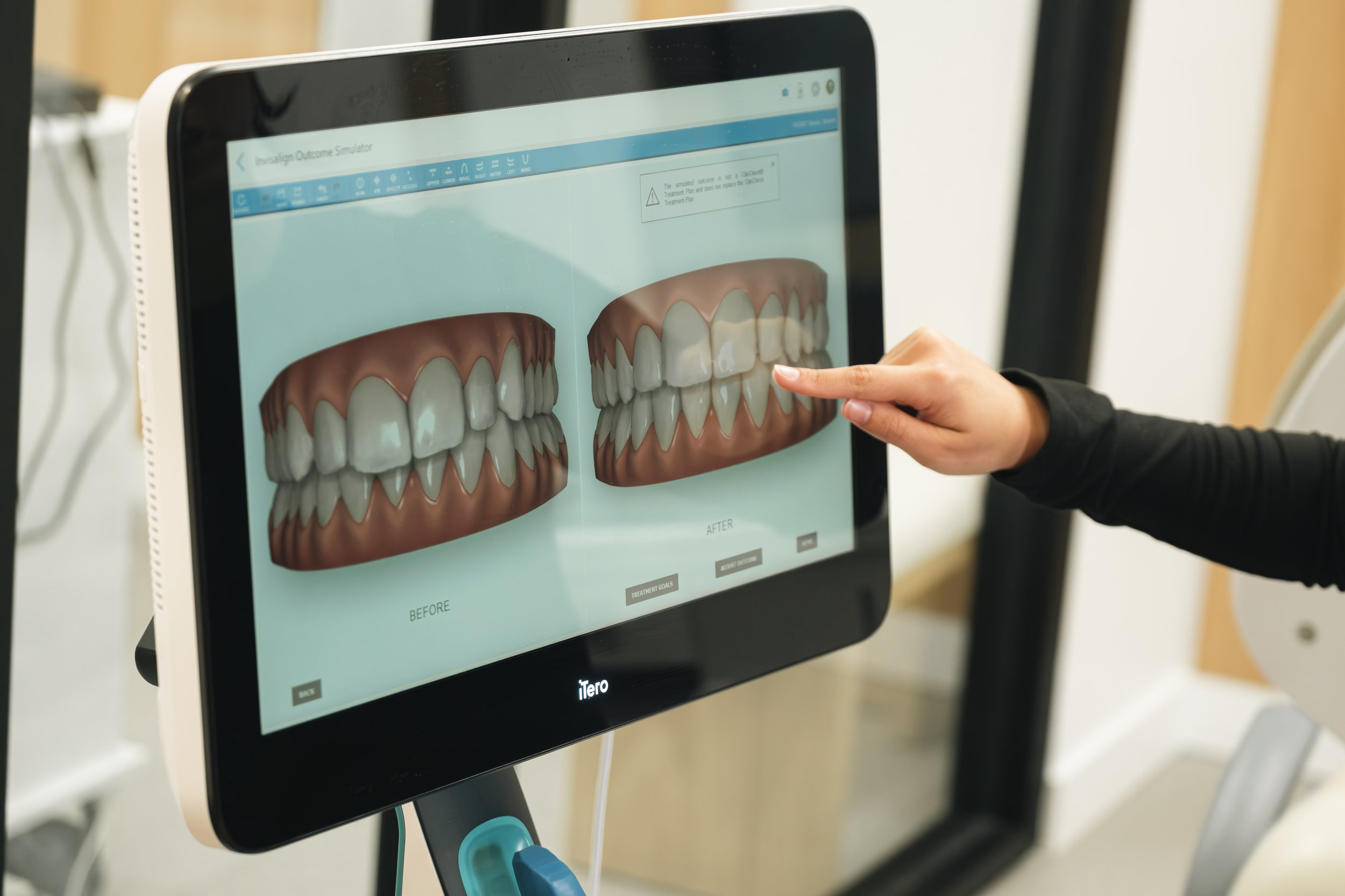 Suis-je un bon candidat pour les aligneurs transparents ?