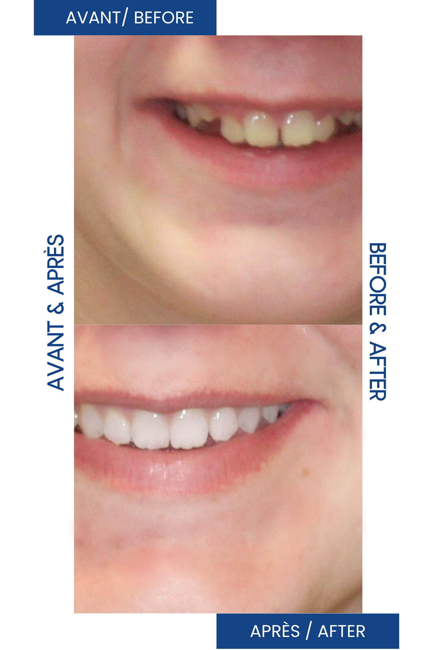 Comparison de sourire montrant avant et après un traitement dentaire, avec un sourire plus blanc et aligné dans l'image du bas.