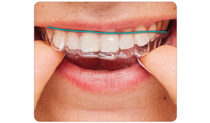 ClearCorrect — Transforming Orthodontics