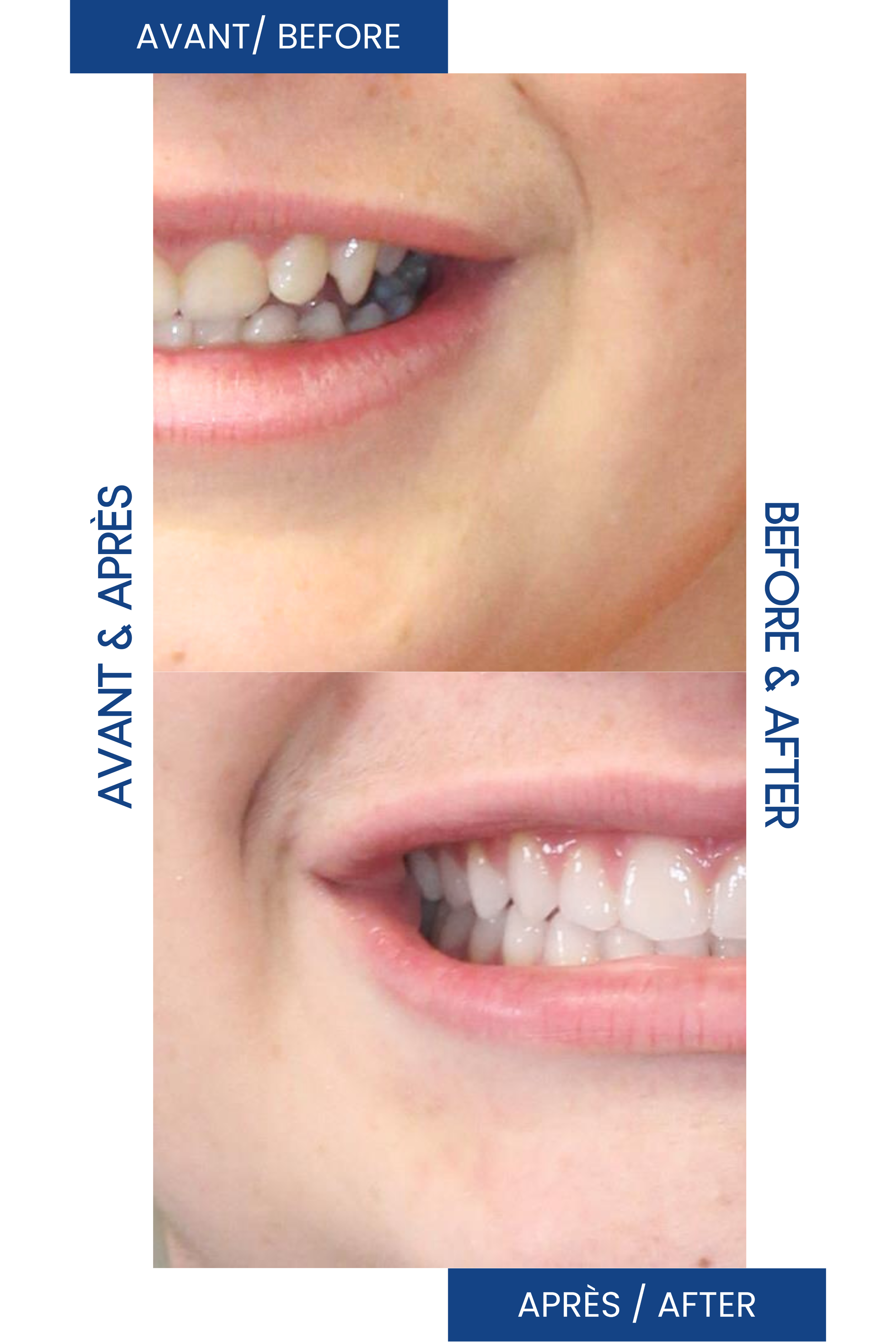 Comparaison de dents avant et après un traitement orthodontique, montrant une amélioration de l'alignement des dents.