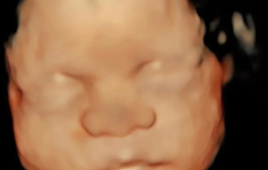Close-up of a 3D ultrasound image showing a fetus's face with closed eyes.
