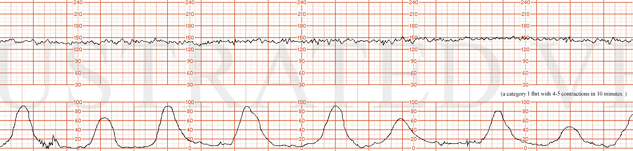 Electronic Fetal Monitoring: Management and Standard of Care Part 3