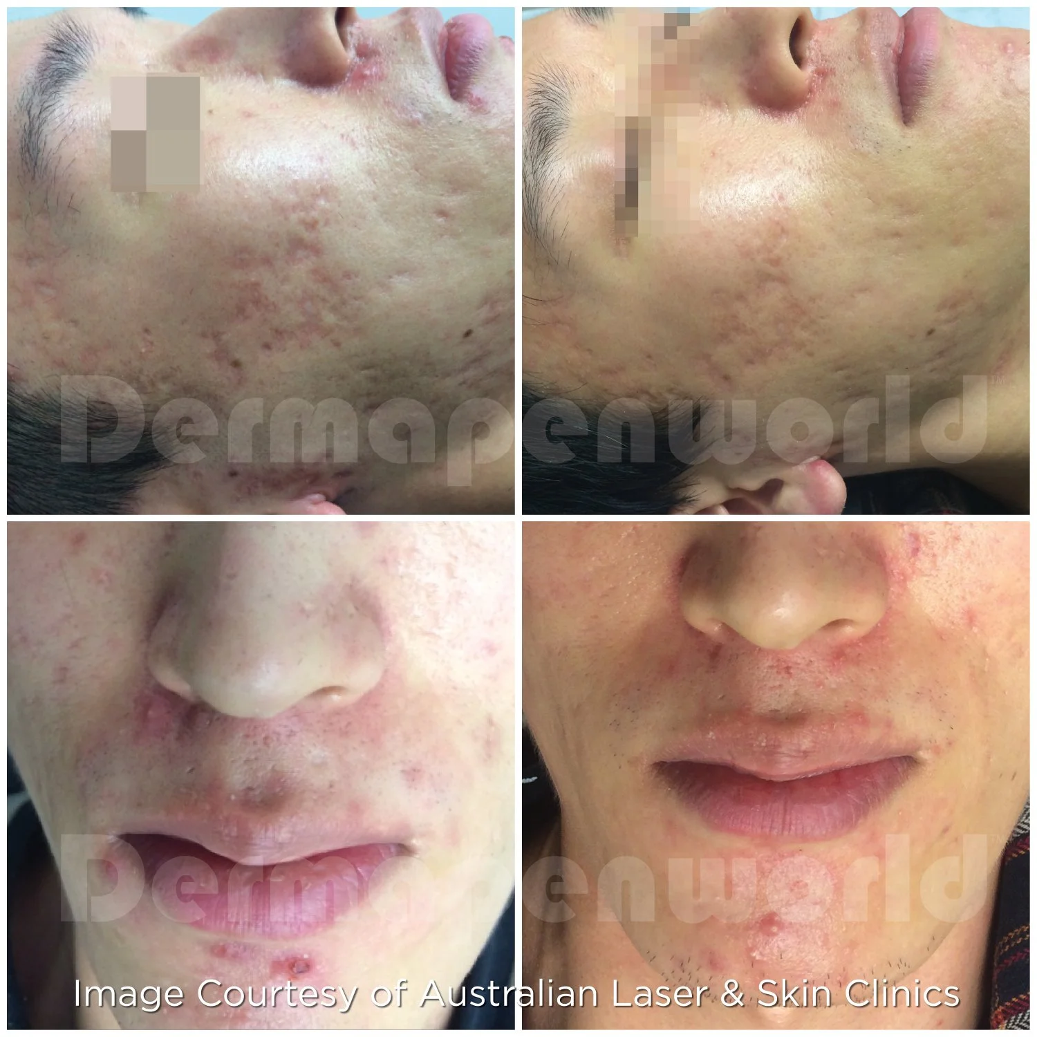 Acne_Scar Male 2.jpg