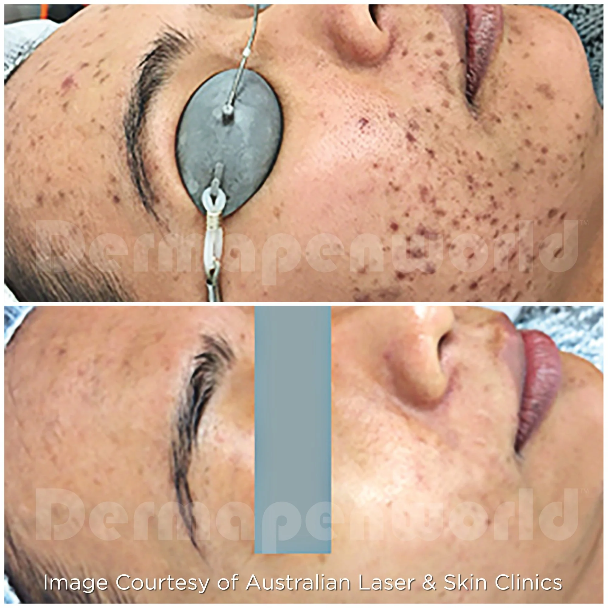 Acne_Female 21.jpg