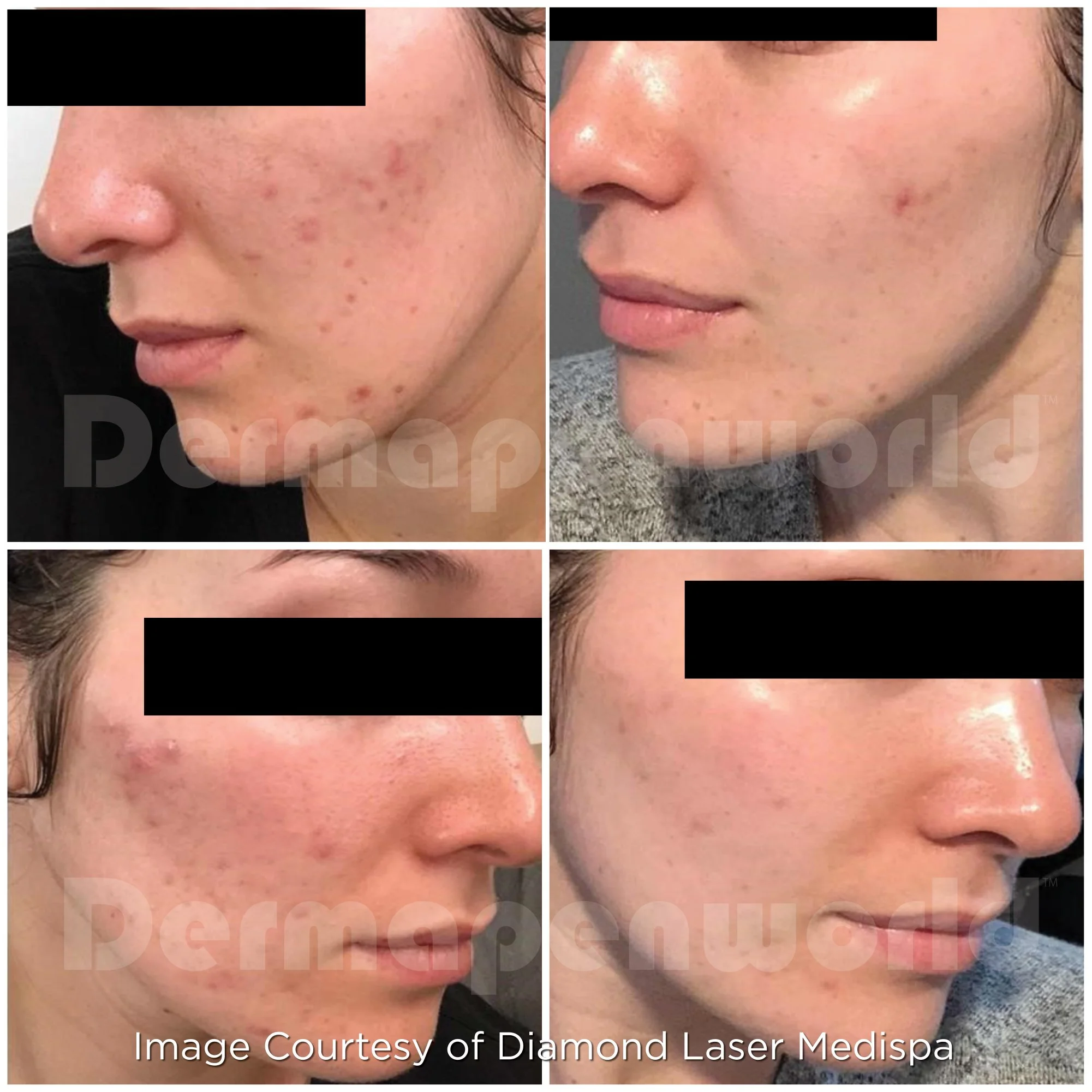 Acne_Female 13.jpg