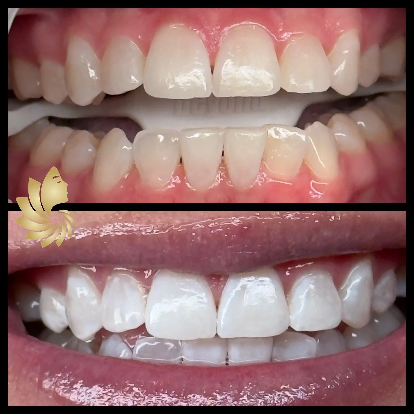 The ONLY time a dull, scary smile is acceptable? When it&rsquo;s part of your Halloween costume. 👻✨

If your smile&rsquo;s looking a little blah, let&rsquo;s fix that. 😘
The results you see here? Just from an annual touch-up. Yep, maintenance can b