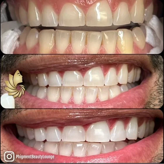 teeth whitening- by crystal.jpeg