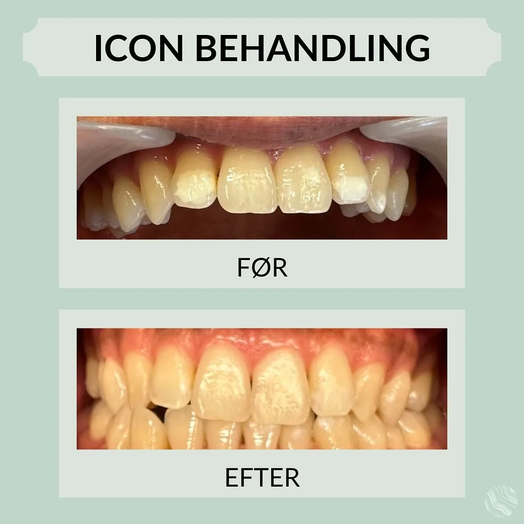 Se lige dette flotte resultat af en Icon behandling, som Isra har lavet på sin patient 🤩
Icon er en væske, som fjerner hvide pletter på tænderne. Behandlingen er skånsom og non-invasiv, og kan bruges til at fjerne de hv