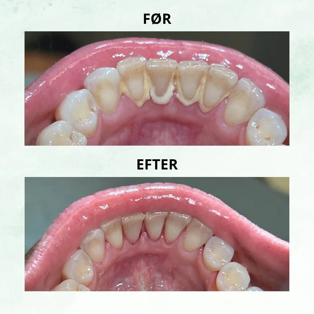 TANDRENSNING før og efter 🦷 Se lige dette fine resultat 🤩
#tandlæge #rosengårdcentret #tandrensning #tænder #sundhed #tandsundhed