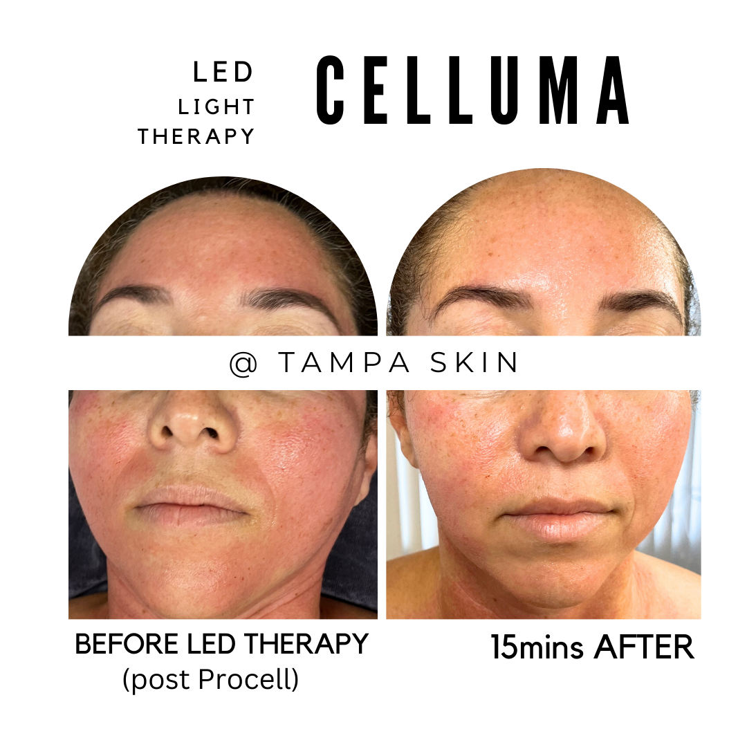 B4 AFTR PROCELL LED.png