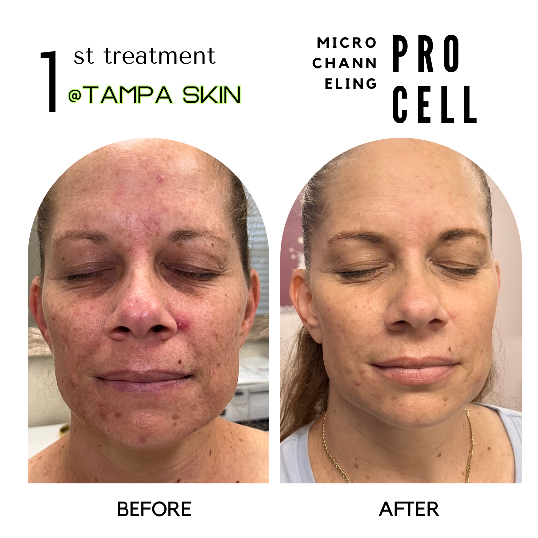 AFTR FACE PROCELL.png