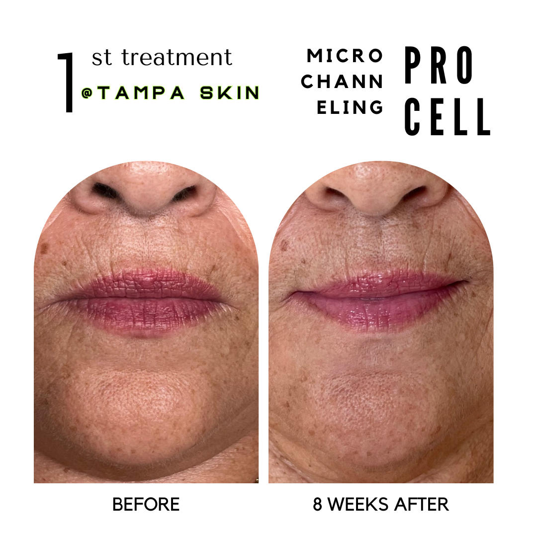 LIPS 8 WKS AFTER PROCELL (1).png