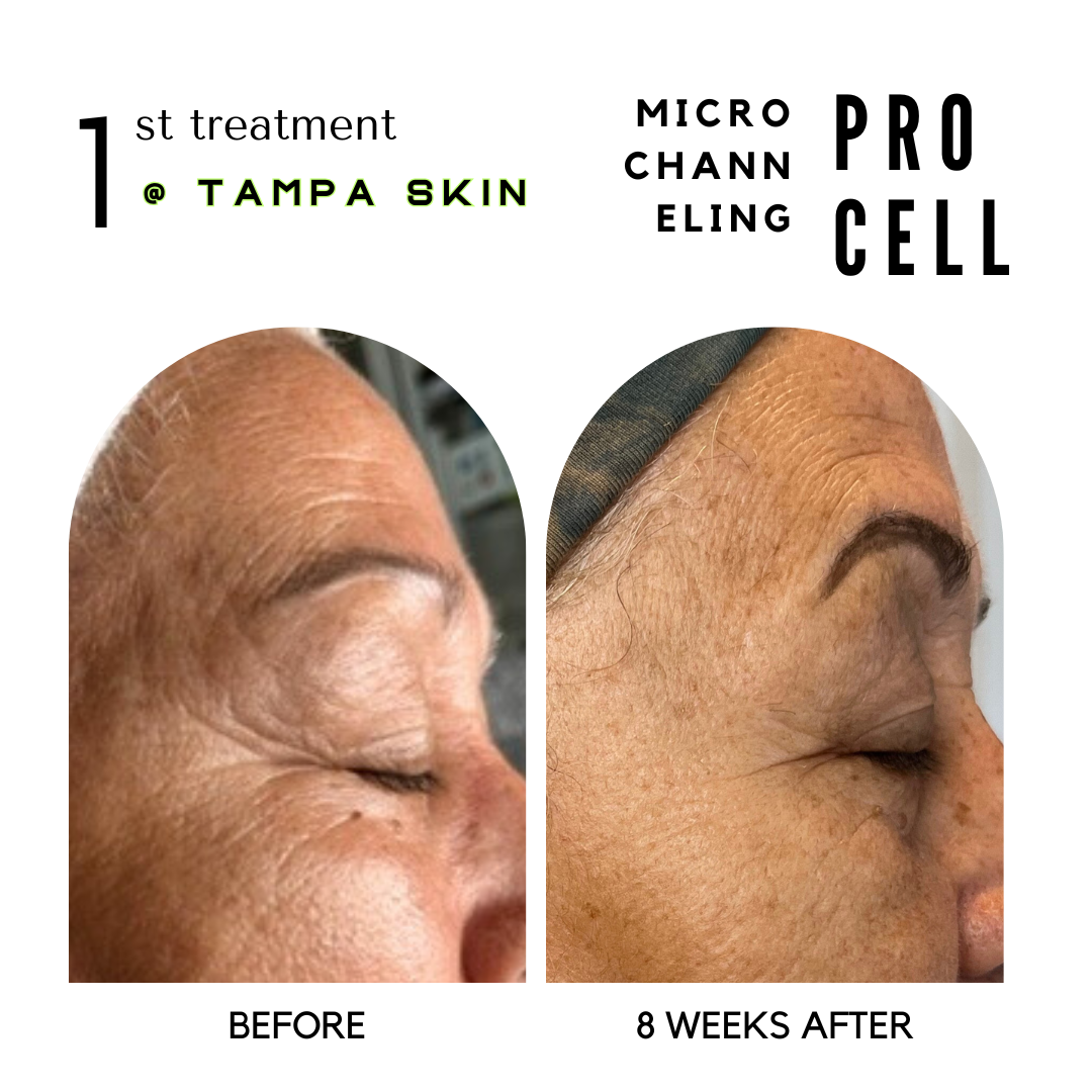 8 WKS AFTER PROCELL.png