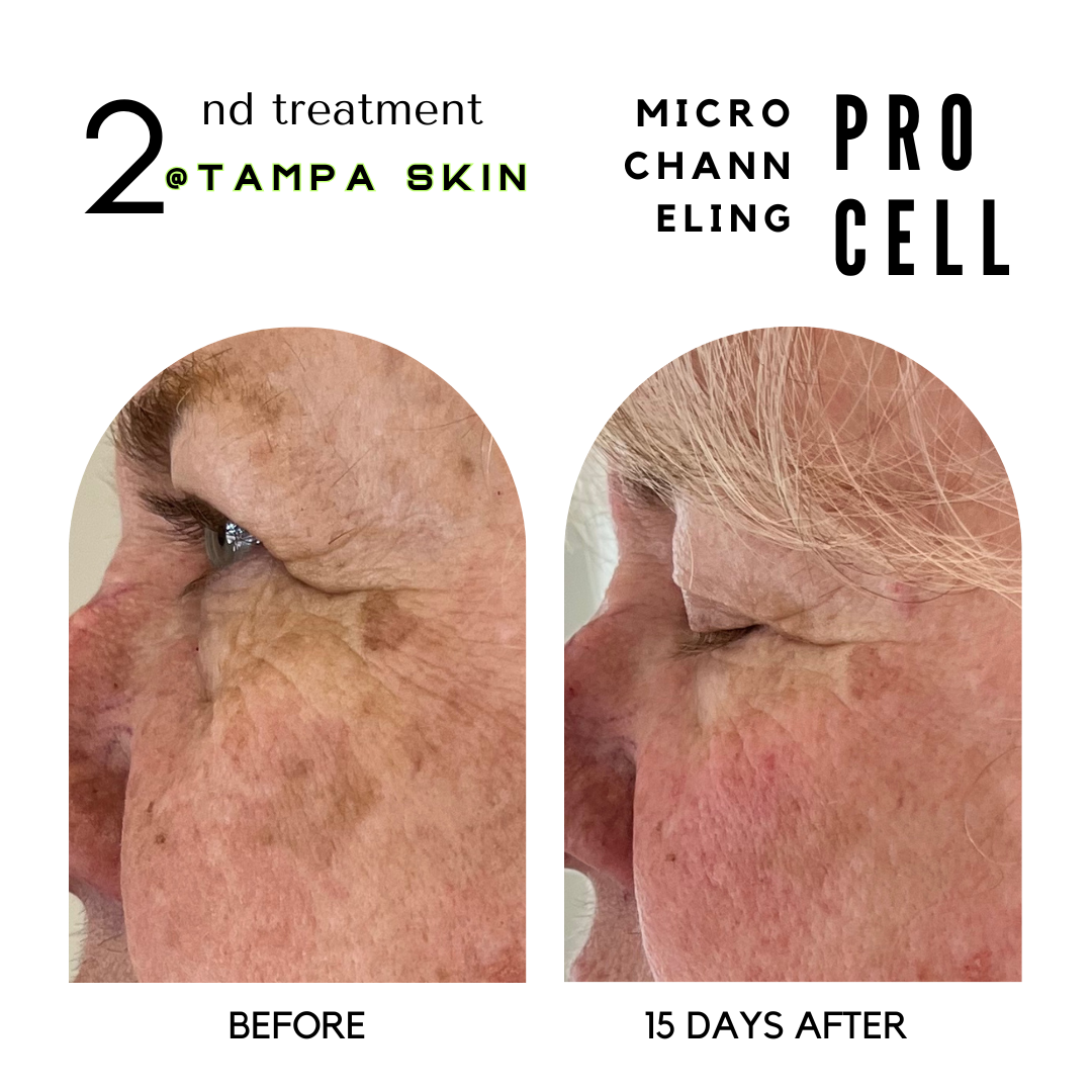 15days after Procell.png