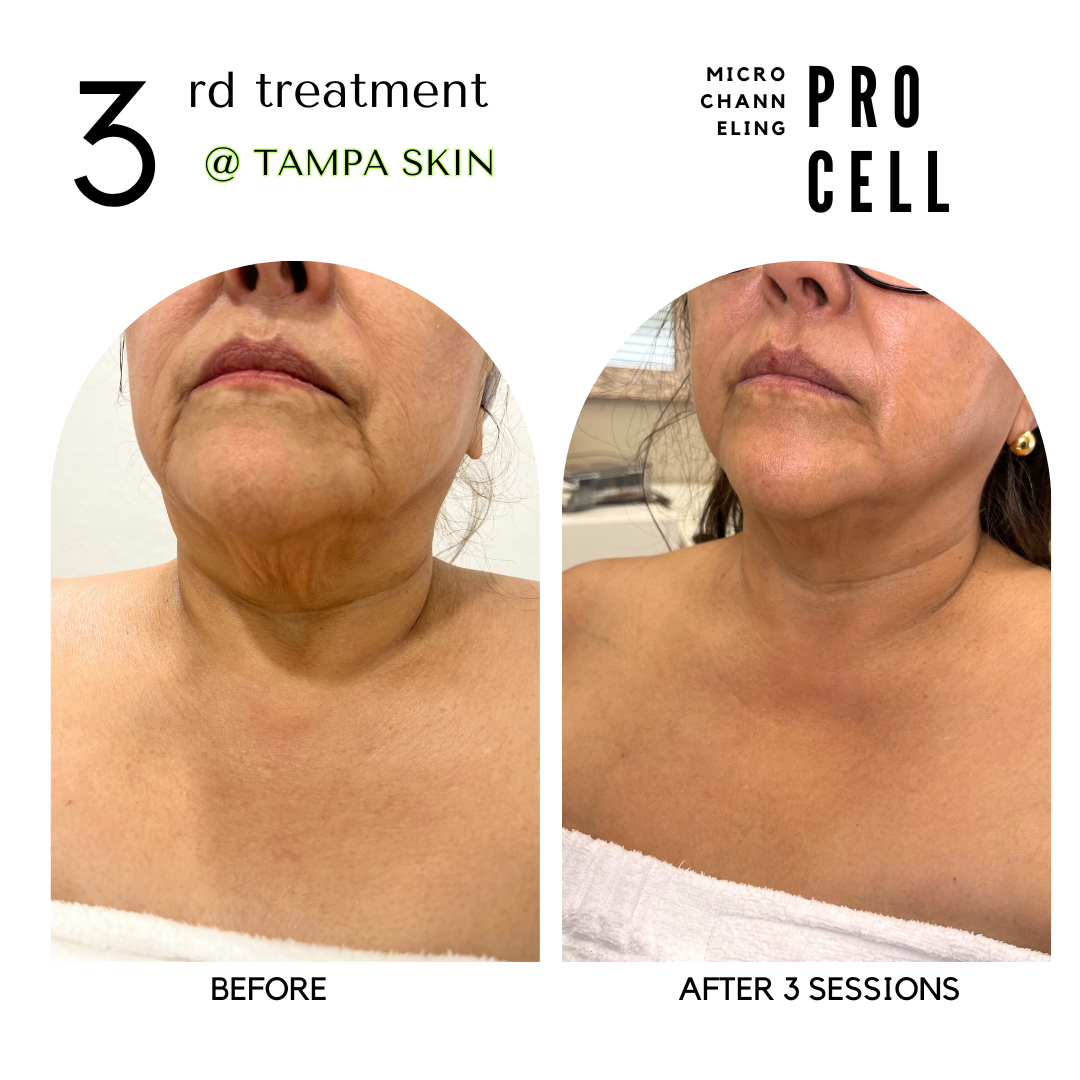 2 N 4 WKS AFTR FACE PROCELL.png