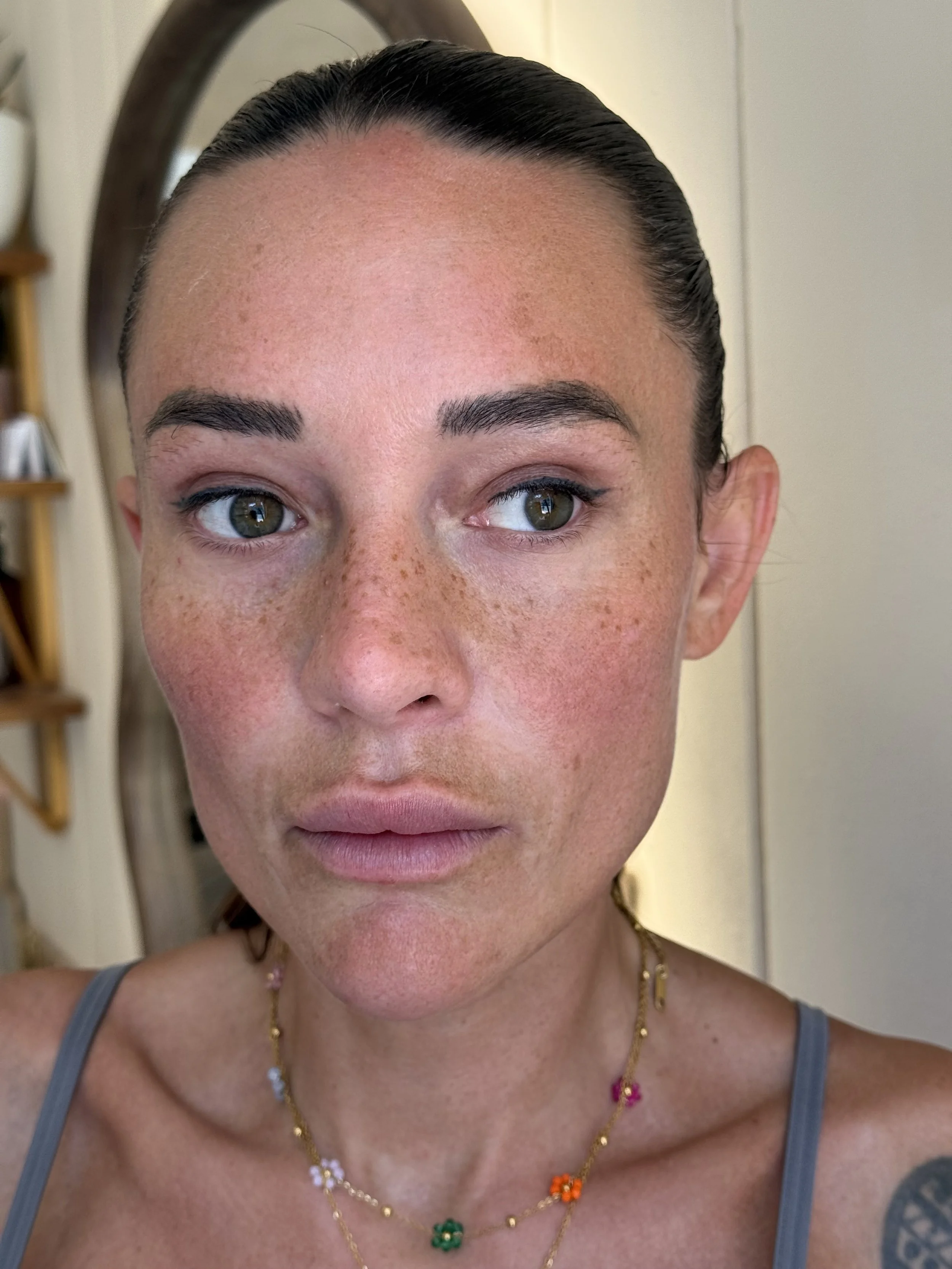 Freckles